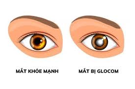 TUẦN LỄ GLÔCÔM THẾ GIỚI NĂM 2025:  "ĐOÀN KẾT ĐỂ THẾ GIỚI HẾT BỆNH GLÔCÔM"